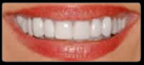 invisalign San Diego for a beautiful smile