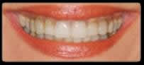 invisalign San Diego for a beautiful smile
