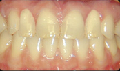 Dental Implants La Mesa