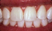 Teeth Whitening La Mesa